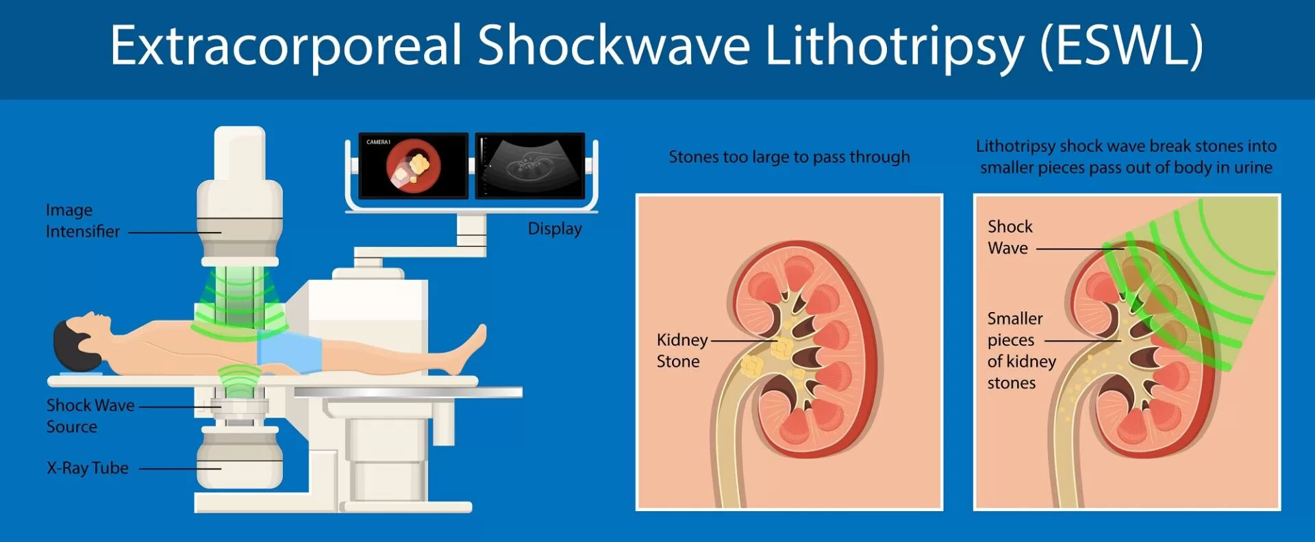 Extracorporeal Shock Wave Lithotripsy Procedure