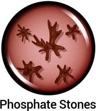 Phosphate Stones