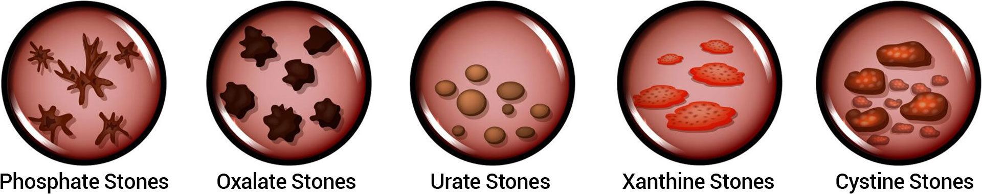 East Coast Mobile Urology different types of kidney-stones